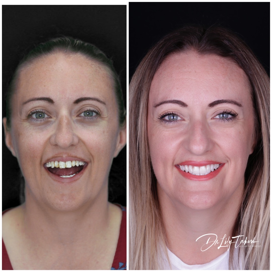 Dental Veneers Perth Connolly Dental Best Cosmetic Dentist