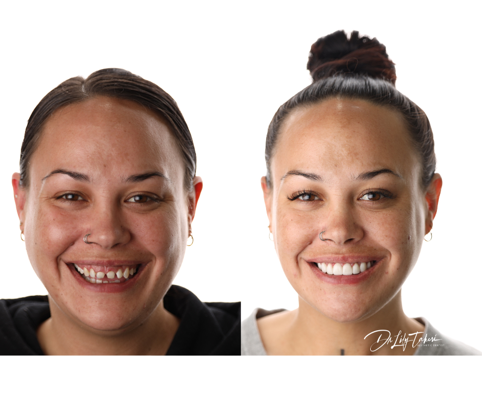 Porcelain Veneers - before and after treatment