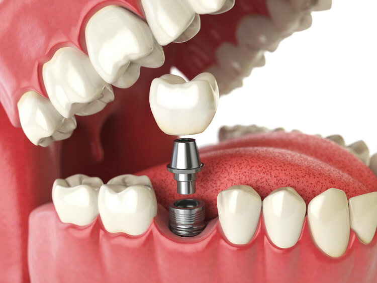 dental implant perth