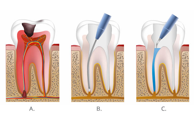 Root canal treatment perth