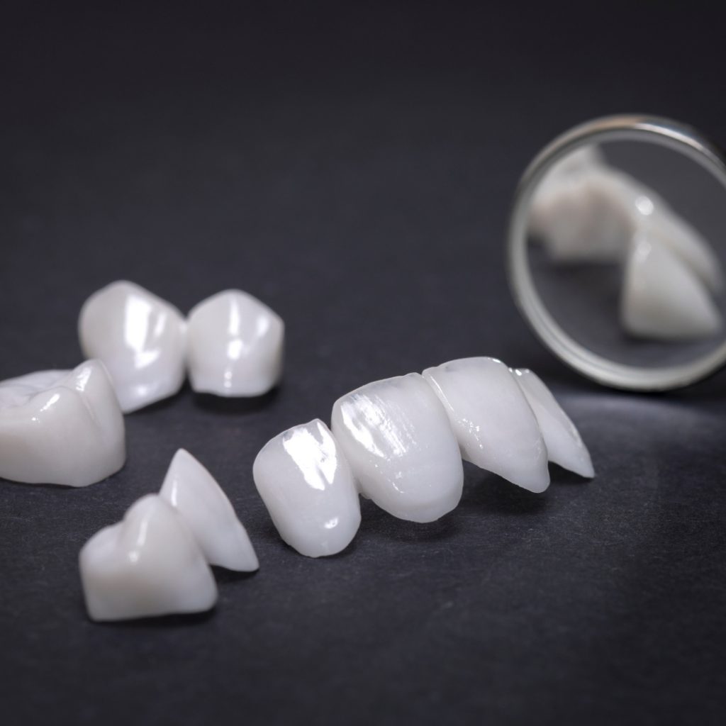 Dental Veneers - Connolly Dental