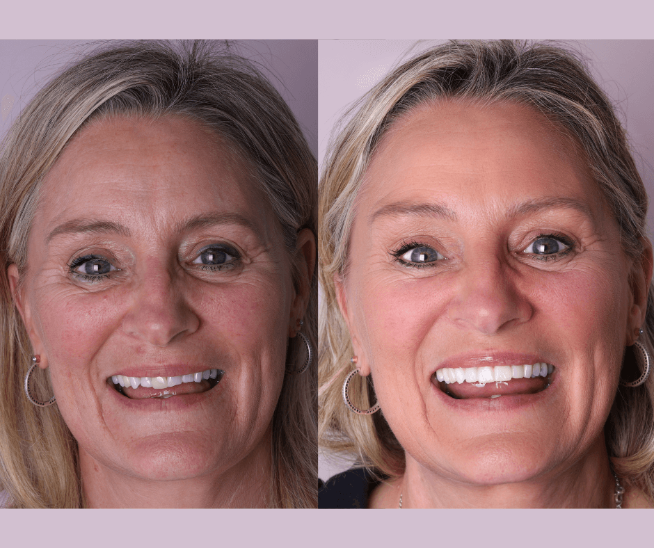 Best Smile makeover Perth - Connolly Dental