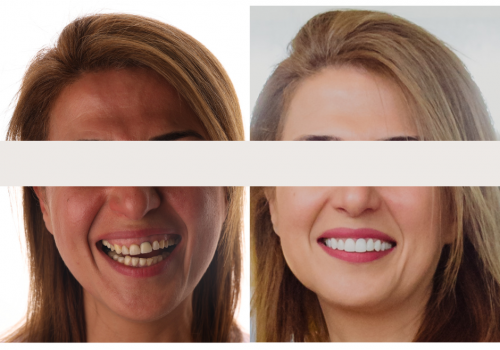 best cosmetic dentist perth - Smile makeover - Connolly dental