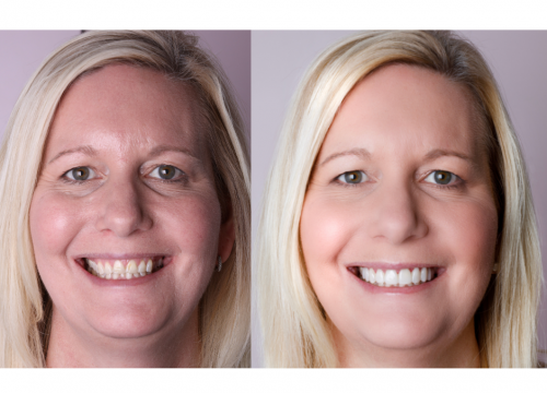 best cosmetic dentist perth - Smile makeover - Connolly dental