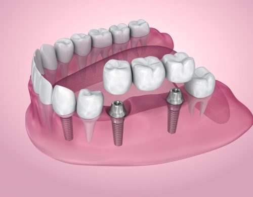 multiple dental implantsa - bridge dental implant